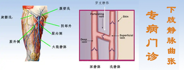 下肢静脉曲张
